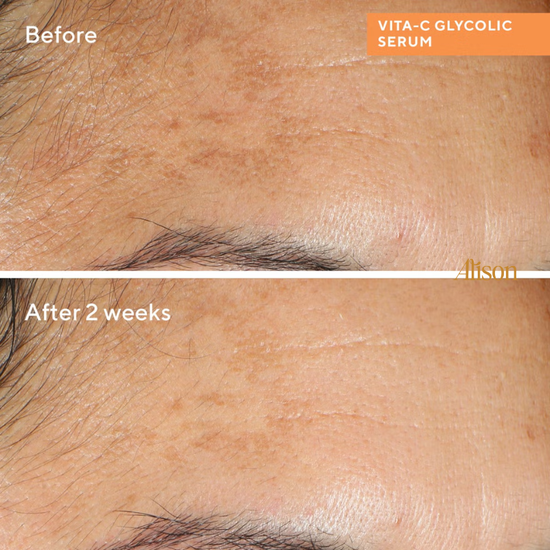 Thumb Tinh chất hỗ trợ sáng da Murad Vita-C Glycolic Serum 30ml