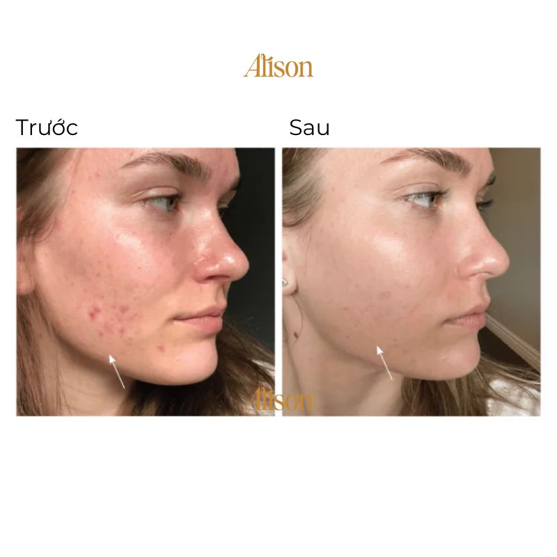 Thumb Viên Uống Giảm Mụn Hush & Hush SkinCapsule Clear+