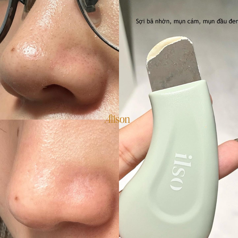 Thumb Thanh Đẩy Mụn Đầu Đen ILSO Deep Clean Master